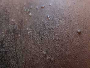 Child with Molluscum