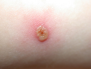 Child with Chickenpox