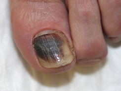 Haematoma