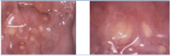 Nabothian follicles