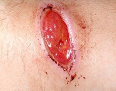 Hypergranulating