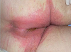 Excoriation