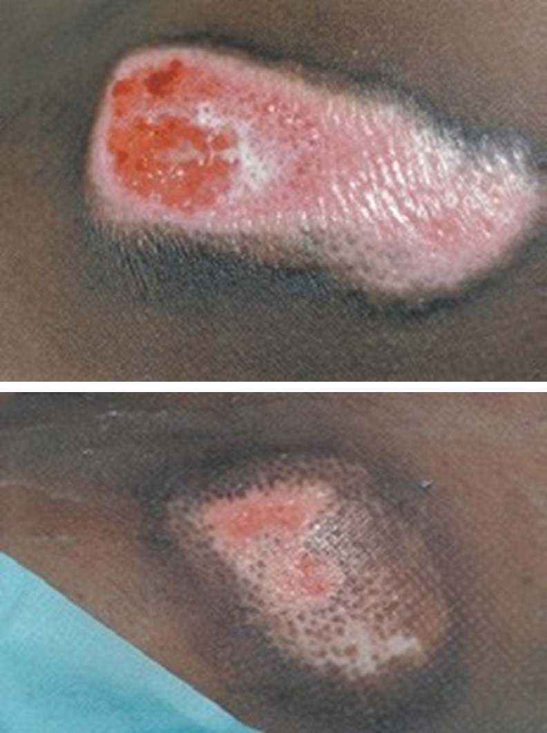 Epithelialising