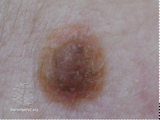 Benign Naevi (moles)