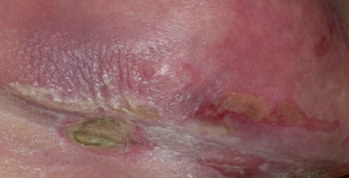 Combination lesions