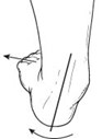 Flat foot